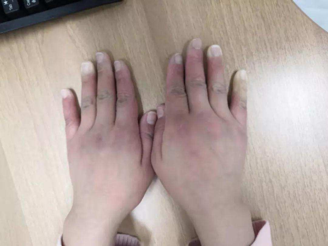 “手指、腳趾發(fā)白、發(fā)紫……”這些“小毛病”千萬(wàn)別大意