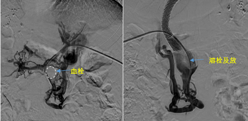 血栓攔路，如何破局——罕見巨大門靜脈血栓TIPS手術(shù)實錄
