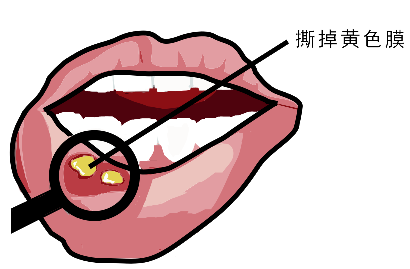 經(jīng)?？谇粷?，真的只是缺維生素嗎？