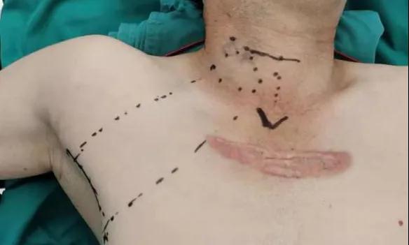 術(shù)后傷口可以“隱身”嗎？