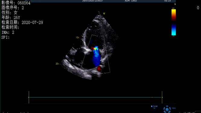 心電圖異常，心臟卻沒事，罪魁禍首是……