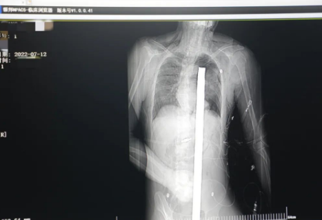 1.2米長的鋼筋貫穿男子胸腹！情況極度危險......