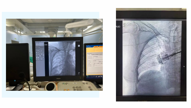 醫(yī)護(hù)攜手為患者打造“隱形生命線(xiàn)”——我院完成上臂港植入術(shù)