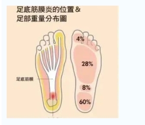 每年新生數(shù)百萬足底筋膜炎患者！國際醫(yī)學(xué)專家提醒：跑步要選擇合適的鞋