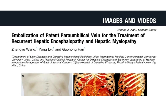 我院護(hù)理團(tuán)隊(duì)臨床成果登榜國(guó)際肝病權(quán)威期刊，影響因子11.6