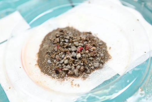 密集恐懼癥慎入！男子腎臟里取出上萬(wàn)顆沙石